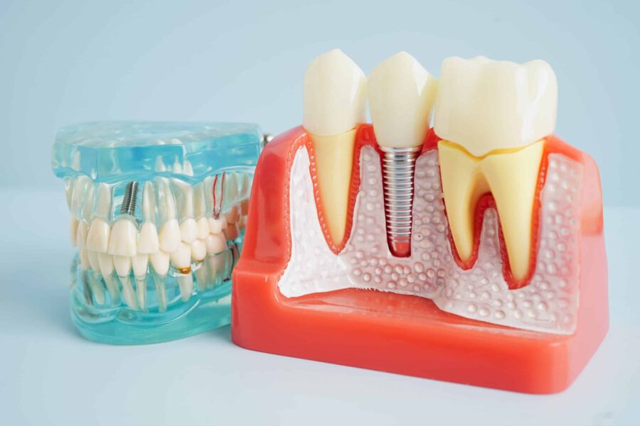 Dental Implants Lubbock