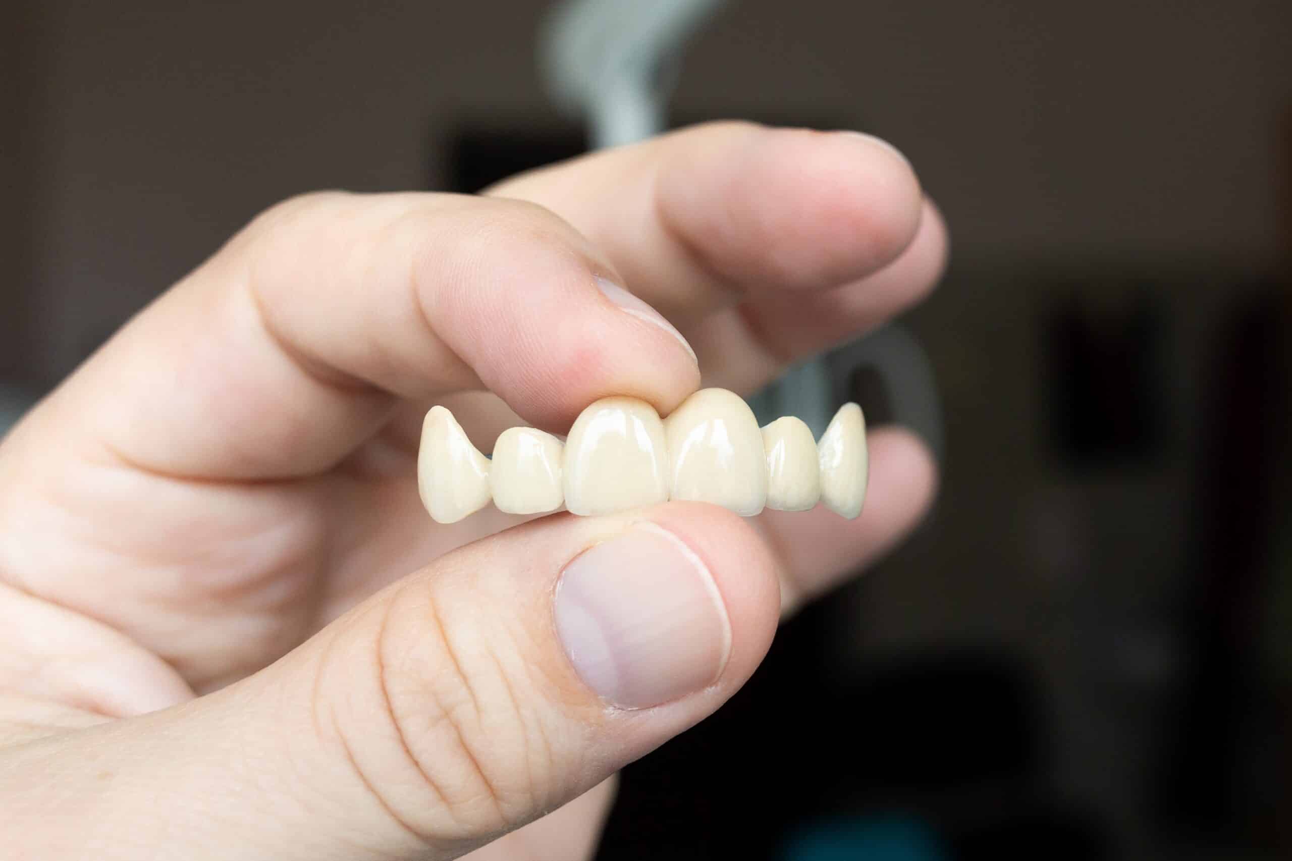 Dental Crowns Lubbock